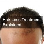 Hair Loss Treatment Explained